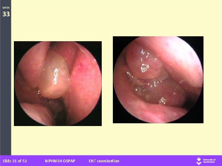 WEEK 33 Slide 31 of 53 MPHM 14 OSPAP ENT examination 