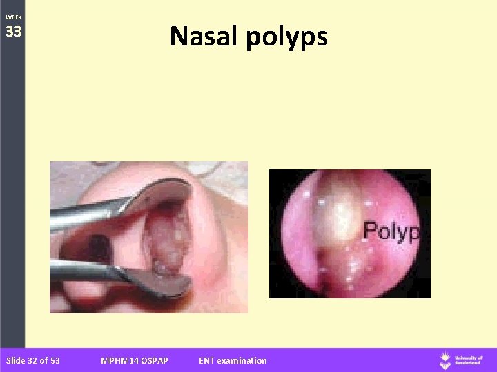 WEEK Nasal polyps 33 Slide 32 of 53 MPHM 14 OSPAP ENT examination 