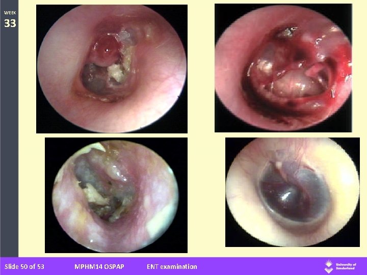 WEEK 33 Slide 50 of 53 MPHM 14 OSPAP ENT examination 