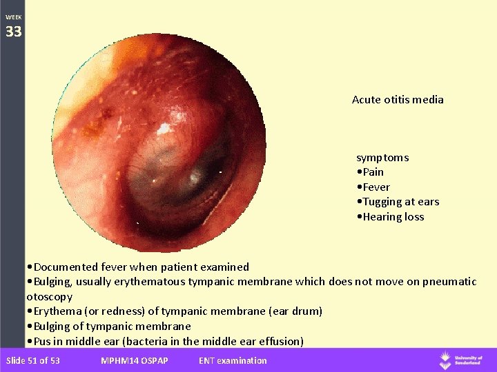 WEEK 33 Acute otitis media symptoms • Pain • Fever • Tugging at ears