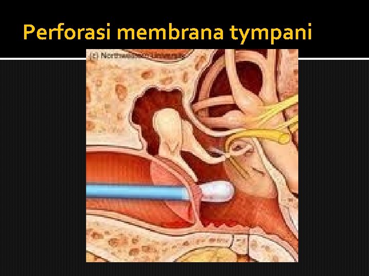 Perforasi membrana tympani 