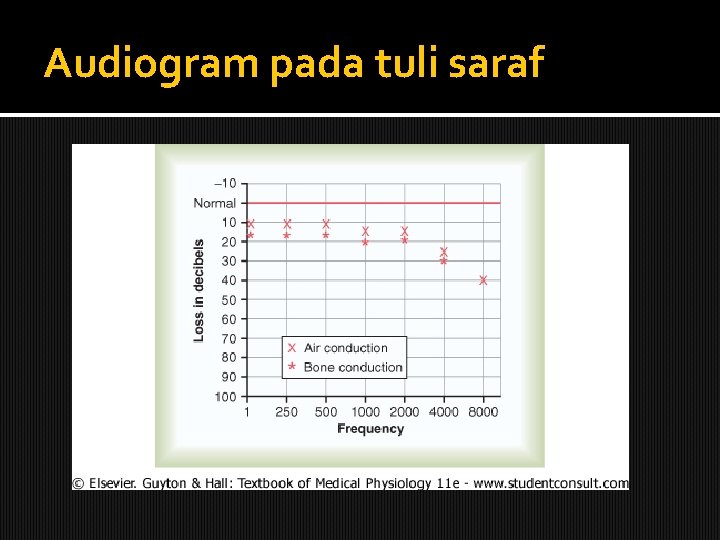 Audiogram pada tuli saraf 