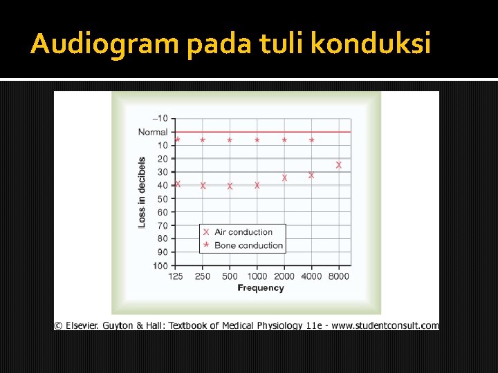 Audiogram pada tuli konduksi 