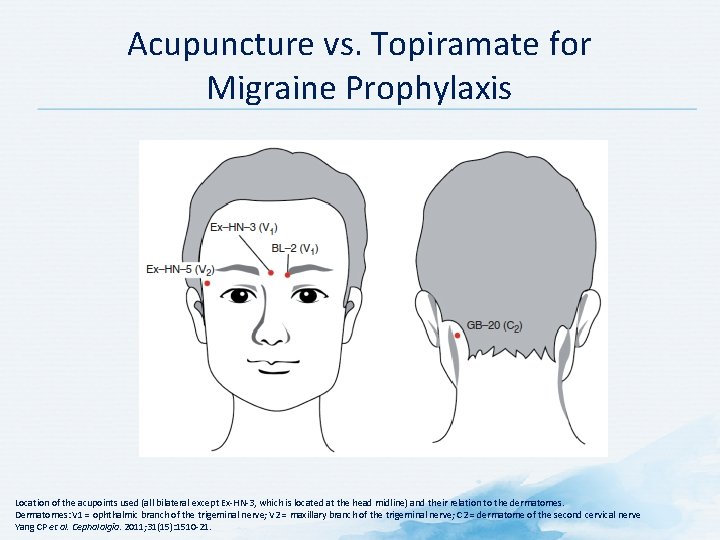 Acupuncture vs. Topiramate for Migraine Prophylaxis Location of the acupoints used (all bilateral except