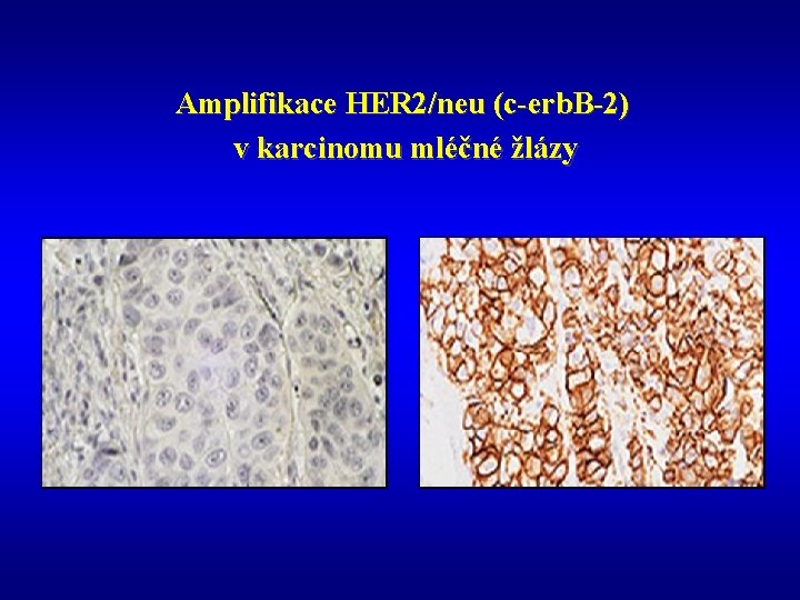 Amplifikace HER 2/neu (c-erb. B-2) v karcinomu mléčné žlázy 