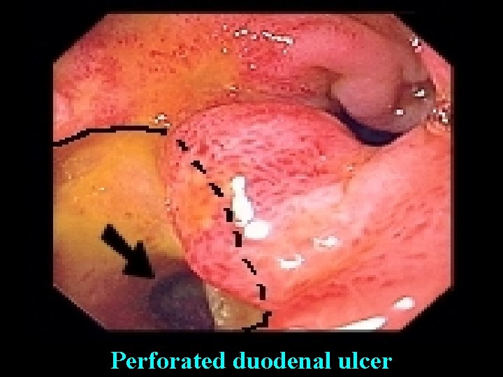 Perforated duodenal ulcer 