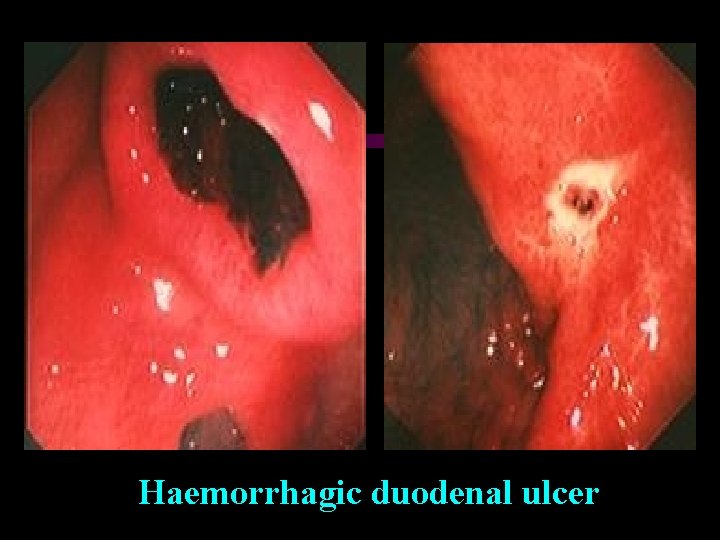 Haemorrhagic duodenal ulcer 