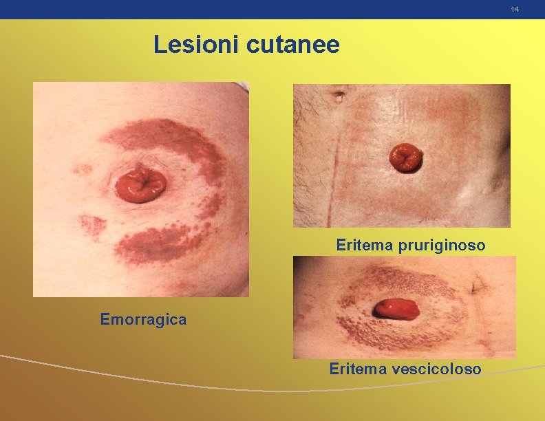 14 Lesioni cutanee Eritema pruriginoso Emorragica Eritema vescicoloso 