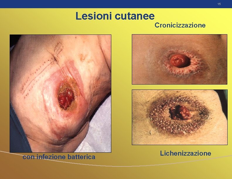 15 Lesioni cutanee Cronicizzazione con infezione batterica Lichenizzazione 