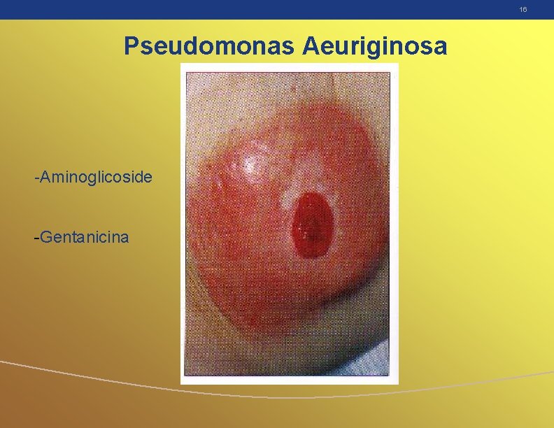 16 Pseudomonas Aeuriginosa -Aminoglicoside -Gentanicina 