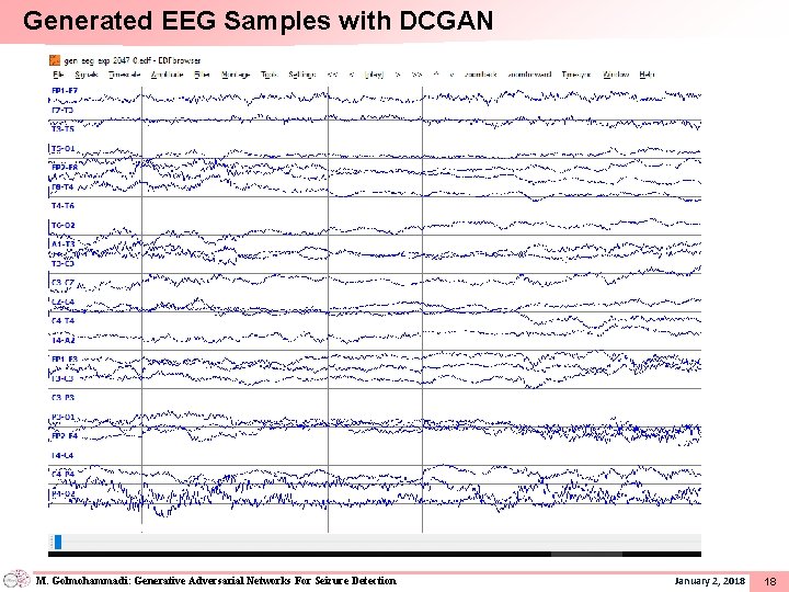 Generated EEG Samples with DCGAN M. Golmohammadi: Generative Adversarial Networks For Seizure Detection January