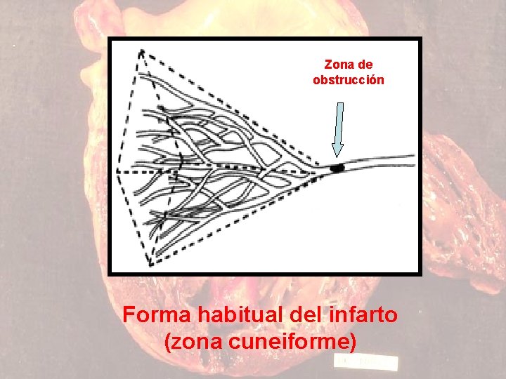 Zona de obstrucción Forma habitual del infarto (zona cuneiforme) 