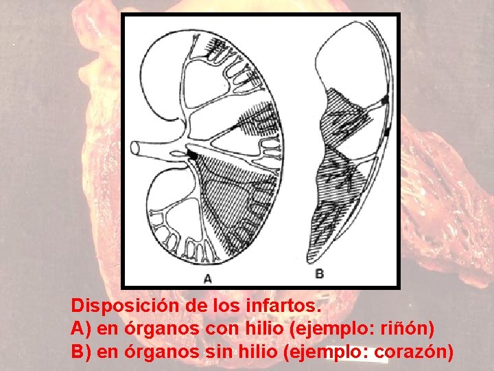 Disposición de los infartos. A) en órganos con hilio (ejemplo: riñón) B) en órganos