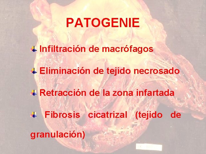 PATOGENIE Infiltración de macrófagos Eliminación de tejido necrosado Retracción de la zona infartada Fibrosis