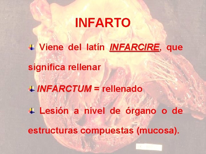 INFARTO Viene del latín INFARCIRE, INFARCIRE que significa rellenar INFARCTUM = rellenado Lesión a