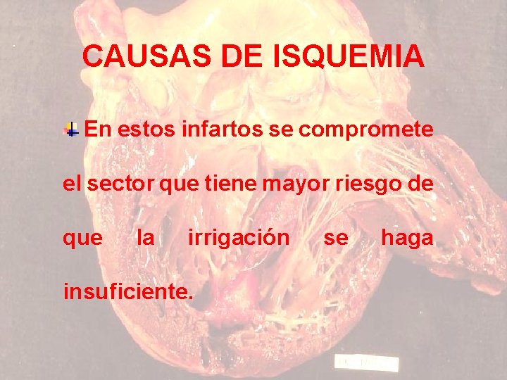 CAUSAS DE ISQUEMIA En estos infartos se compromete el sector que tiene mayor riesgo