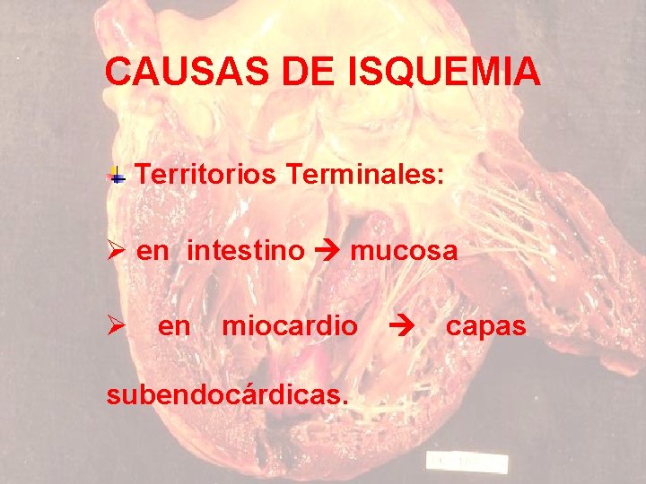CAUSAS DE ISQUEMIA Territorios Terminales: Ø en intestino mucosa Ø en miocardio subendocárdicas. capas