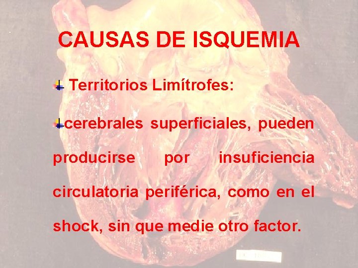 CAUSAS DE ISQUEMIA Territorios Limítrofes: cerebrales superficiales, pueden producirse por insuficiencia circulatoria periférica, como