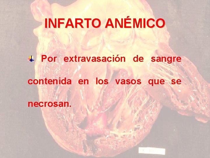 INFARTO ANÉMICO Por extravasación de sangre contenida en los vasos que se necrosan. 