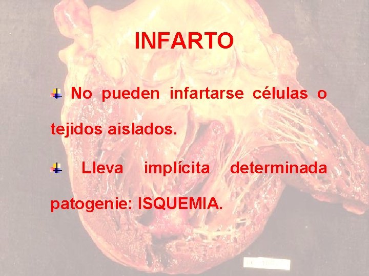 INFARTO No pueden infartarse células o tejidos aislados. Lleva implícita patogenie: ISQUEMIA. determinada 