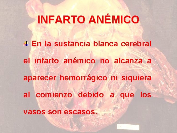 INFARTO ANÉMICO En la sustancia blanca cerebral el infarto anémico no alcanza a aparecer