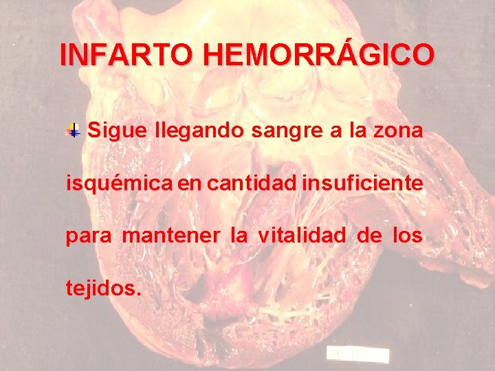 INFARTO HEMORRÁGICO Sigue llegando sangre a la zona isquémica en cantidad insuficiente para mantener