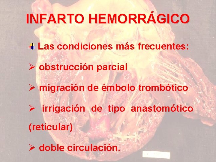 INFARTO HEMORRÁGICO Las condiciones más frecuentes: Ø obstrucción parcial Ø migración de émbolo trombótico