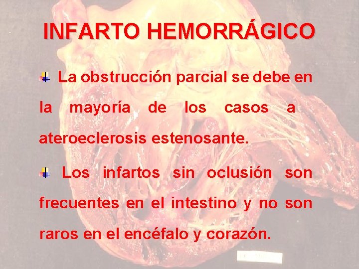 INFARTO HEMORRÁGICO La obstrucción parcial se debe en la mayoría de los casos a