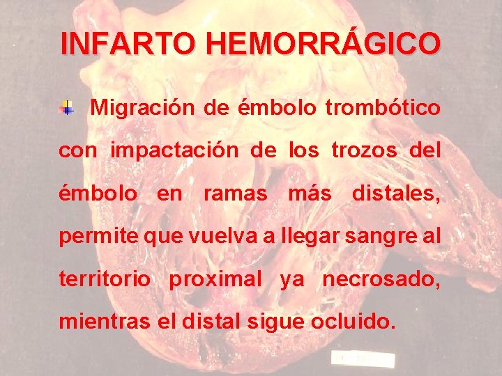 INFARTO HEMORRÁGICO Migración de émbolo trombótico con impactación de los trozos del émbolo en