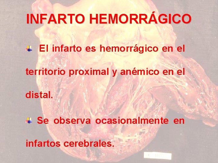 INFARTO HEMORRÁGICO El infarto es hemorrágico en el territorio proximal y anémico en el