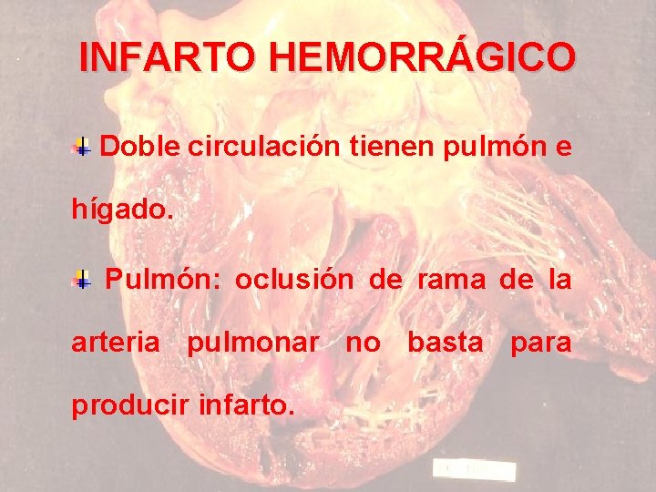 INFARTO HEMORRÁGICO Doble circulación tienen pulmón e hígado. Pulmón: oclusión de rama de la