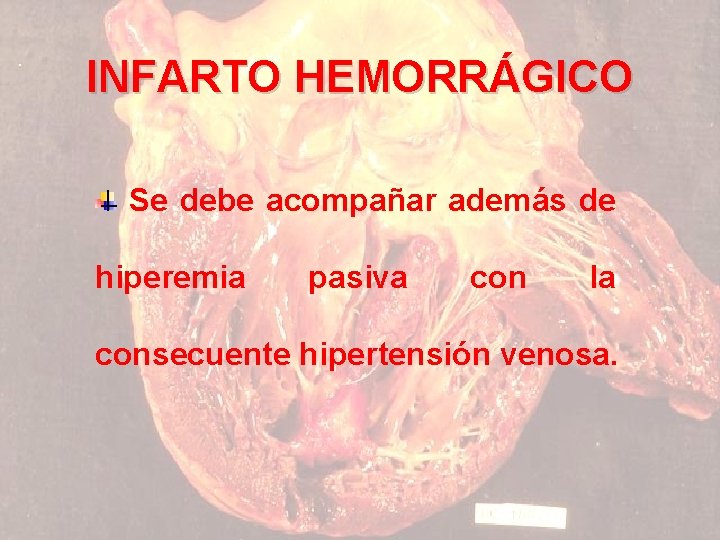 INFARTO HEMORRÁGICO Se debe acompañar además de hiperemia pasiva con la consecuente hipertensión venosa.