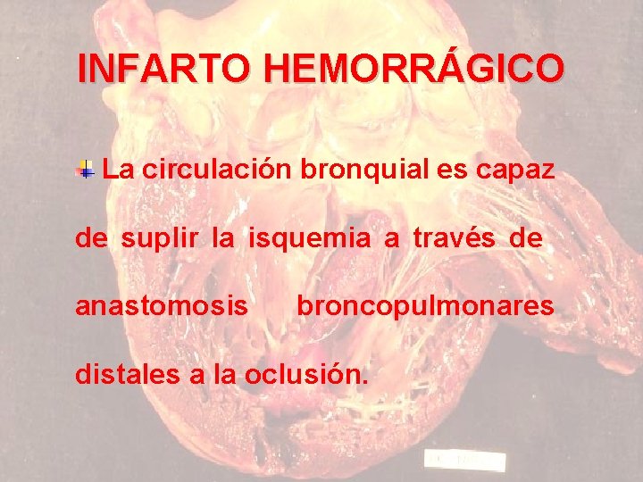 INFARTO HEMORRÁGICO La circulación bronquial es capaz de suplir la isquemia a través de