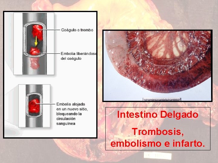 Intestino Delgado Trombosis, embolismo e infarto. 