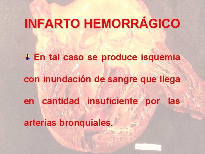 INFARTO HEMORRÁGICO En tal caso se produce isquemia con inundación de sangre que llega