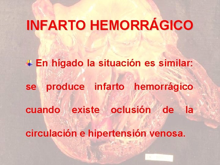 INFARTO HEMORRÁGICO En hígado la situación es similar: se produce infarto hemorrágico cuando existe