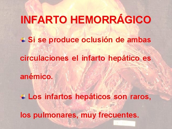 INFARTO HEMORRÁGICO Si se produce oclusión de ambas circulaciones el infarto hepático es anémico.