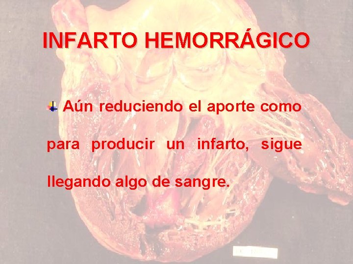 INFARTO HEMORRÁGICO Aún reduciendo el aporte como para producir un infarto, sigue llegando algo