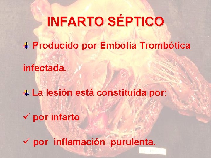 INFARTO SÉPTICO Producido por Embolia Trombótica infectada. La lesión está constituida por: ü por