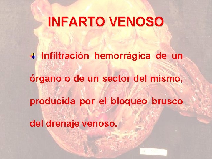 INFARTO VENOSO Infiltración hemorrágica de un órgano o de un sector del mismo, producida