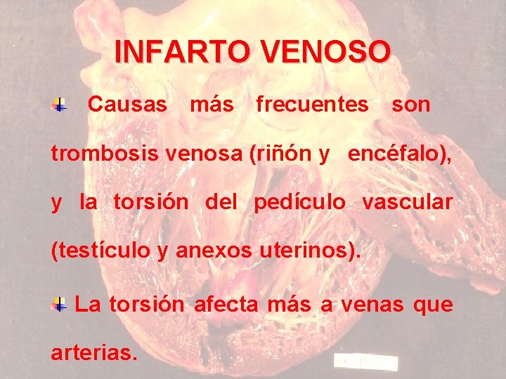 INFARTO VENOSO Causas más frecuentes son trombosis venosa (riñón y encéfalo), y la torsión