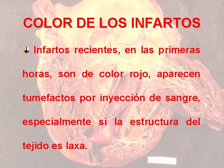 COLOR DE LOS INFARTOS Infartos recientes, en las primeras horas, son de color rojo,