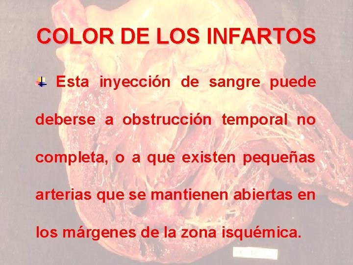 COLOR DE LOS INFARTOS Esta inyección de sangre puede deberse a obstrucción temporal no