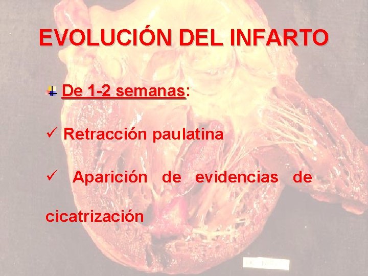 EVOLUCIÓN DEL INFARTO De 1 -2 semanas: semanas ü Retracción paulatina ü Aparición de