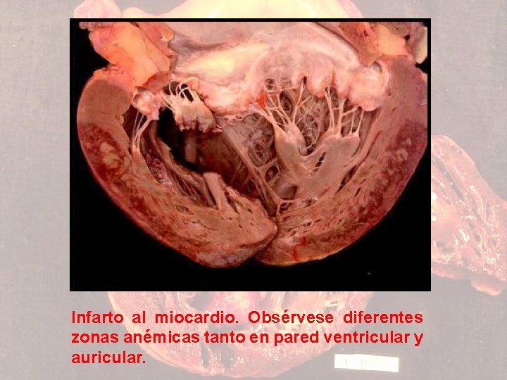 Infarto al miocardio. Obsérvese diferentes zonas anémicas tanto en pared ventricular y auricular. 