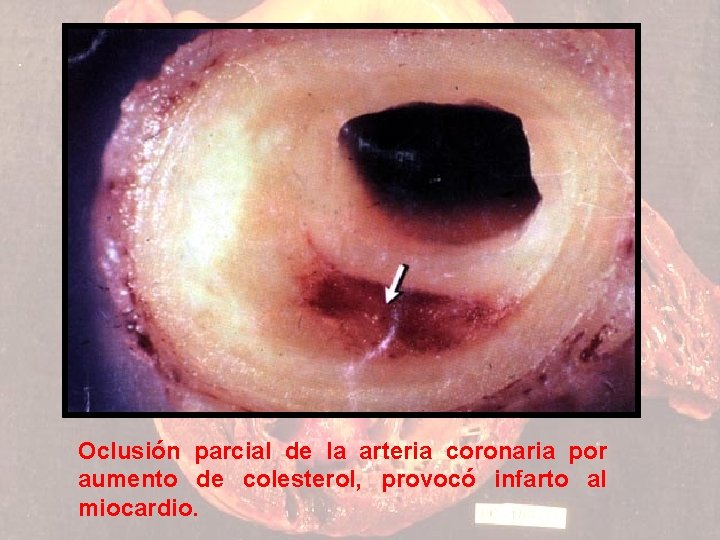 Oclusión parcial de la arteria coronaria por aumento de colesterol, provocó infarto al miocardio.