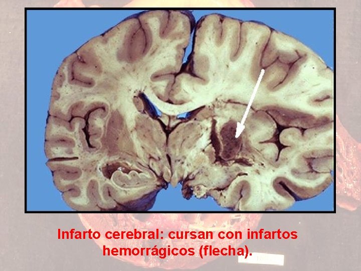 Infarto cerebral: cursan con infartos hemorrágicos (flecha). 