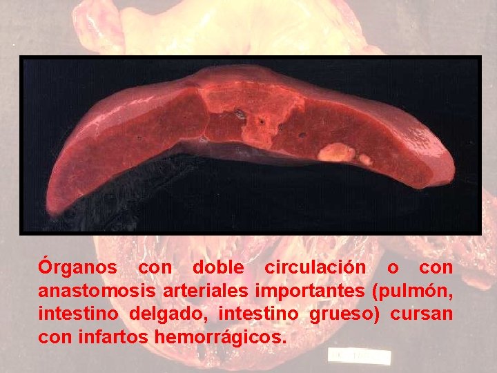 Órganos con doble circulación o con anastomosis arteriales importantes (pulmón, intestino delgado, intestino grueso)