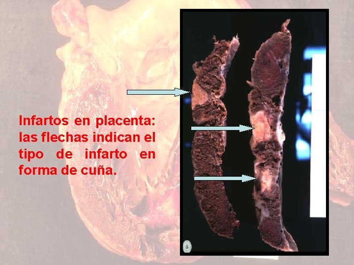 Infartos en placenta: las flechas indican el tipo de infarto en forma de cuña.