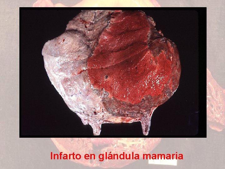 Infarto en glándula mamaria 